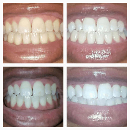 LumaSmile™ RadiancePen - Precision Enamel Restoration Formula